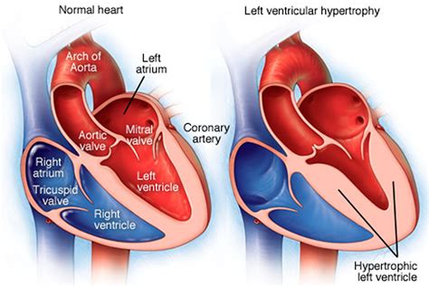 left ventricular hypertrophy muscle mass.